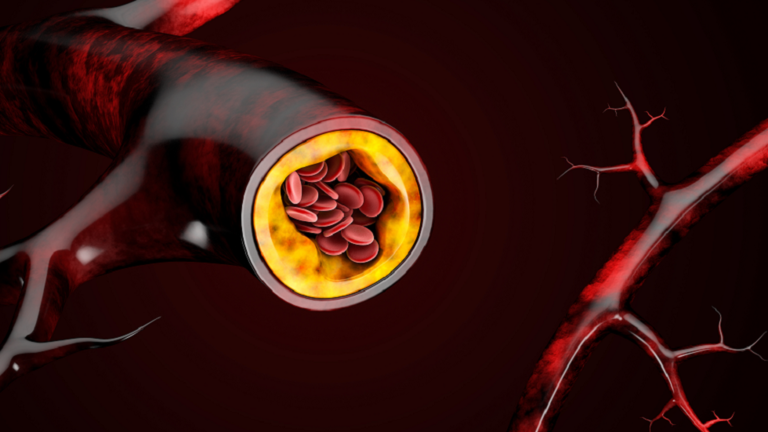 ارتفاع نسبة الكوليسترول: شعور في ذراعيك قد يدل على انسداد الشرايين!