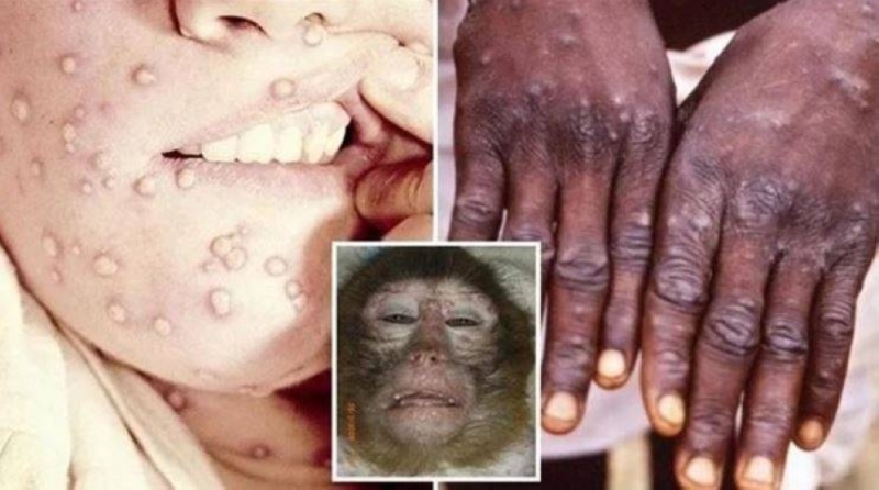 الصحة العالمية تعلن عن تطورات جديدة بشأن جدري القرود .. وتكشف عن أمر سار حول المرض